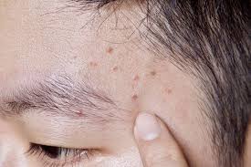 Global Perspectives on Folliculitis: Ayurveda's Approach to Prevention, Treatment, and Healthcare Disparities