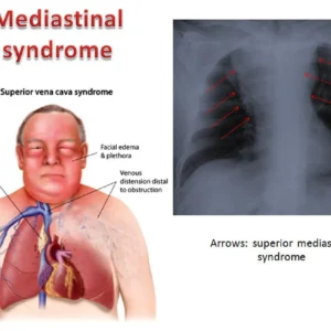 Mediastinum anatomy globeayush.com