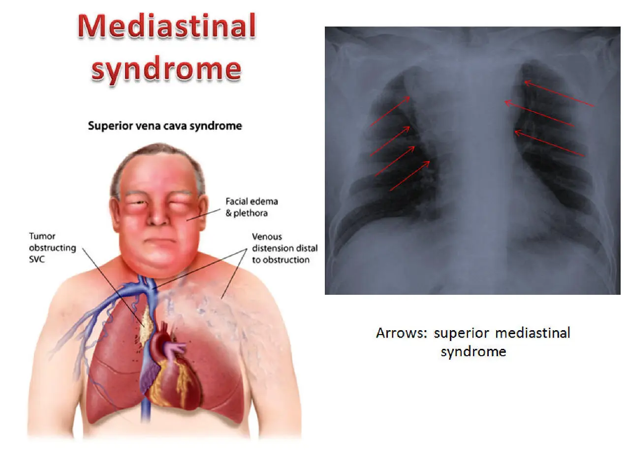 Mediastinum anatomy globeayush.com 