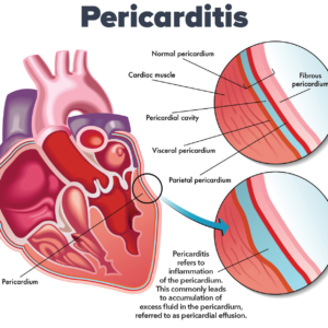 Comprehensive View Of Pericardium: Understanding Anatomy, Function, Development and Congenital Anomalies ,Clinical Significance