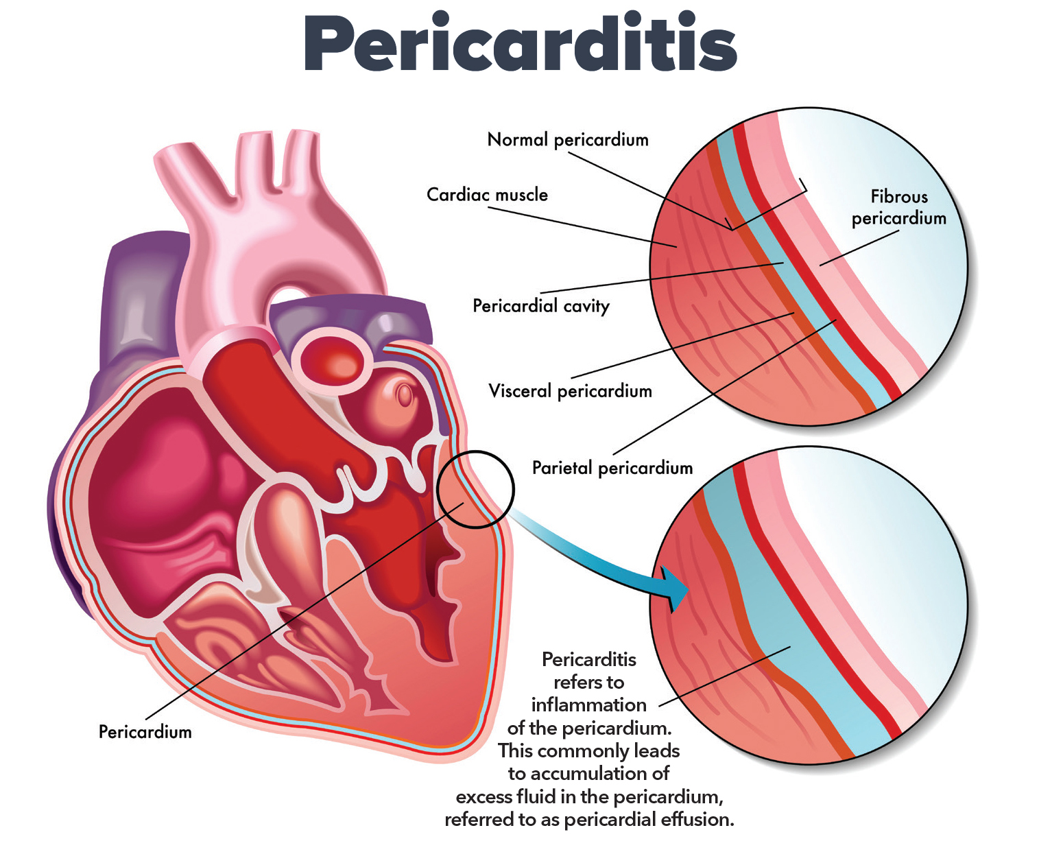 Comprehensive View Of Pericardium: Understanding Anatomy, Function, Development and Congenital Anomalies ,Clinical Significance