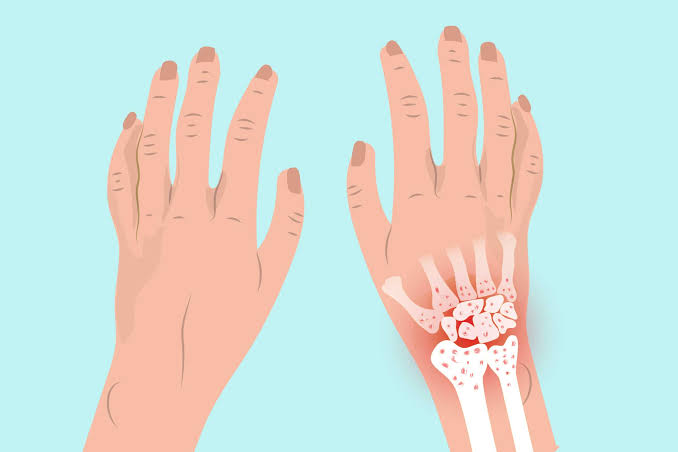 Arthritis explore Ayurvedic and Modern Aspects