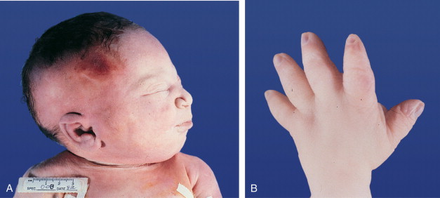 Understanding Of Renal Agenesis :  Symptoms , Causes , Diagnosis and Treatment