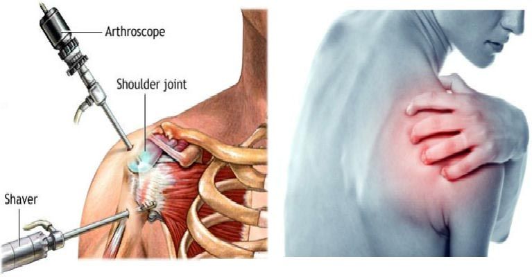 Frozen shoulder ayurvedic and modern aspects