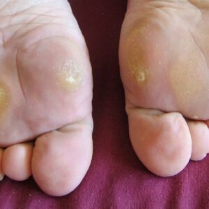 Read more about the article Corn (Clavus) — Causes, Symptoms, Diagnosis & Ayurvedic & Modern Treatment: A Complete Clinical Guide