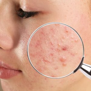 Read more about the article Acne Vulgaris: Diagnostic Aspects and Clinical Assessment – An Integrative Ayurvedic and Modern Perspective