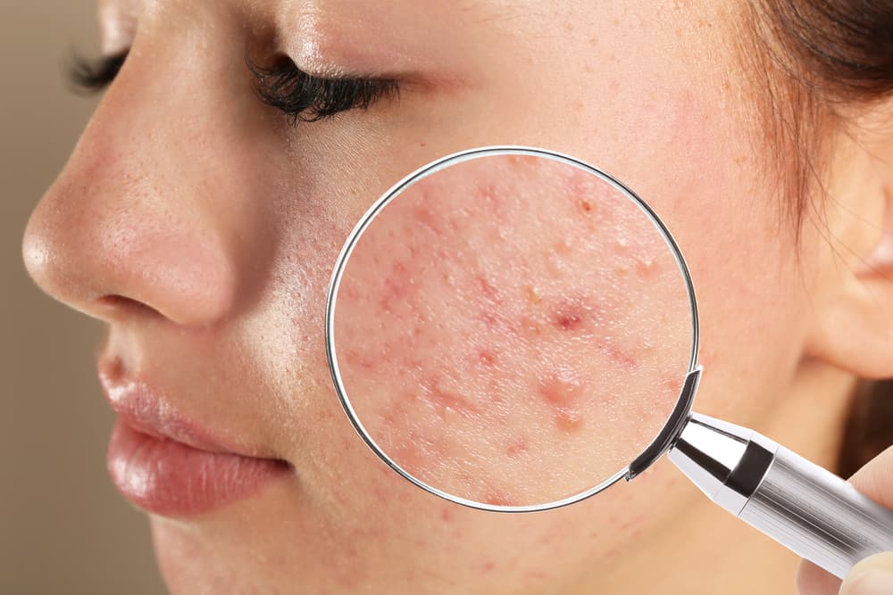 Acne Vulgaris: Diagnostic Aspects and Clinical Assessment – An Integrative Ayurvedic and Modern Perspective