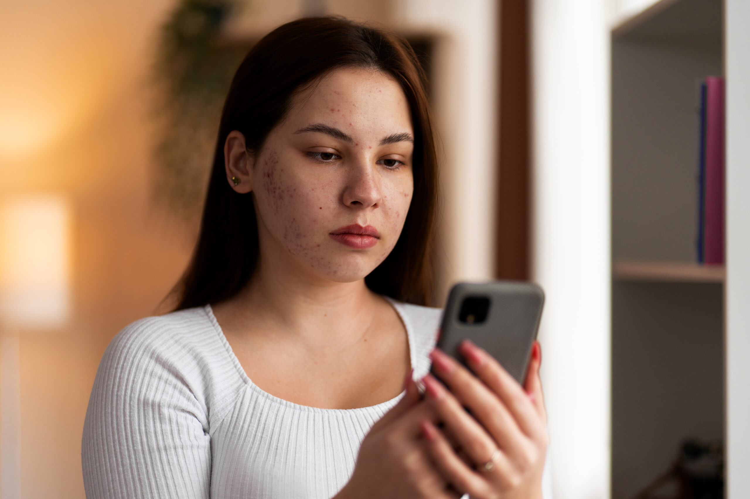 Acne Vulgaris: Integrative Ayurvedic and Modern Therapeutic Protocols