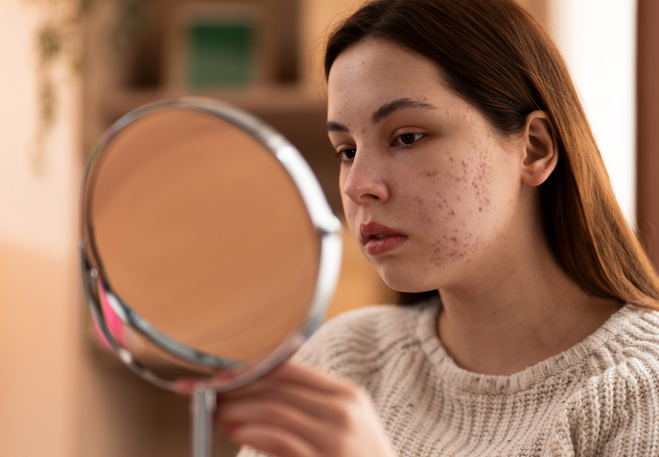 Acne Vulgaris,  globeayush.com